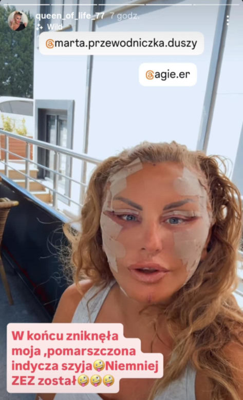 Dagmara Kaźmierska po operacji twarzy