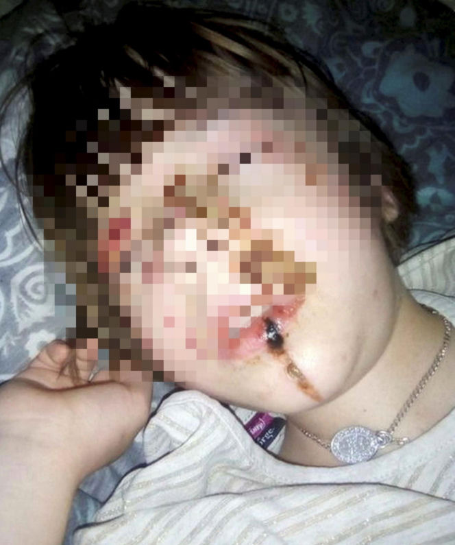 Wyrodna matka zgotowała Julce piekło. Latami wypalała jej kwasem rany na skórze!