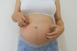 Zmiany skórne w ciąży to norma. Są jednak takie, które powinnaś pokazać lekarzowi