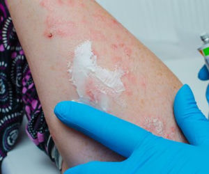 Jakie metody leczenia stosuje dermatolog