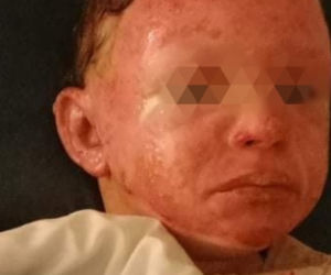 Dramat rodziny po wybuchu gazu. Ciężko poparzone dzieci.  Łzy na naszych policzkach płyną nieustannie [DRASTYCZNE ZDJĘCIA]