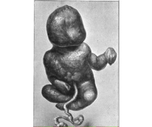 Przypadki „dzieci z kamienia” opisywano już w X wieku