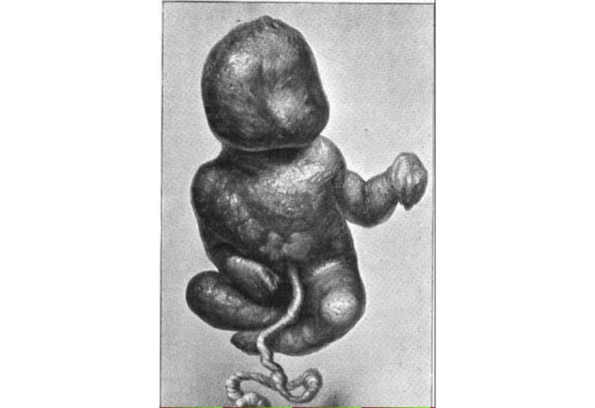 Przypadki „dzieci z kamienia” opisywano już w X wieku