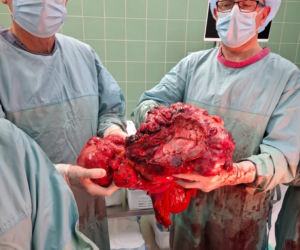 Sosnowieccy lekarze wycięli wielkiego guza
