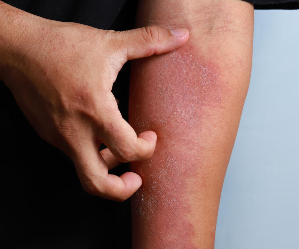 Osoba drapiąca zaczerwienione i łuszczące się ramię z egzemą, symbolizujące silny świąd i podrażnienie skóry. Więcej o objawach i leczeniu egzemy przeczytasz na Poradnik Zdrowie.