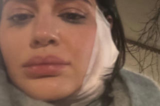 Honorata Skarbek pokazała obandażowaną twarz