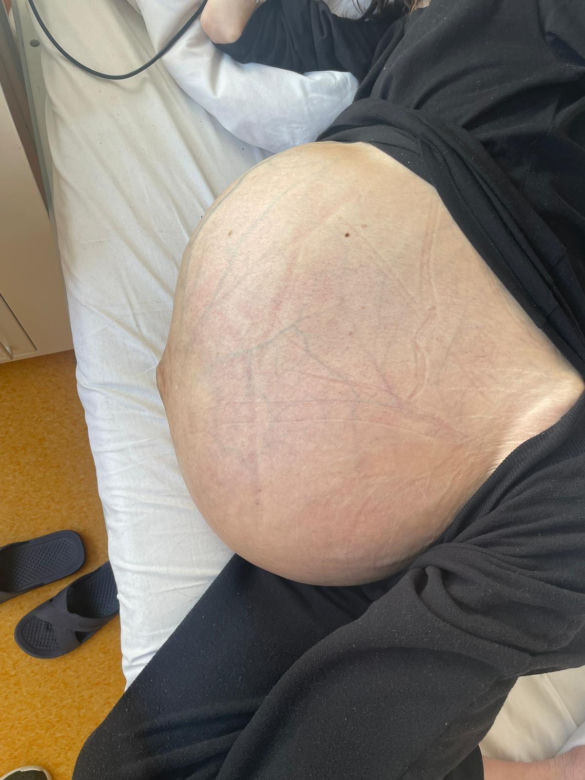 Lekarze ze szpitala Latawiec usunęli gigantycznego guza 38-letniej pacjentce