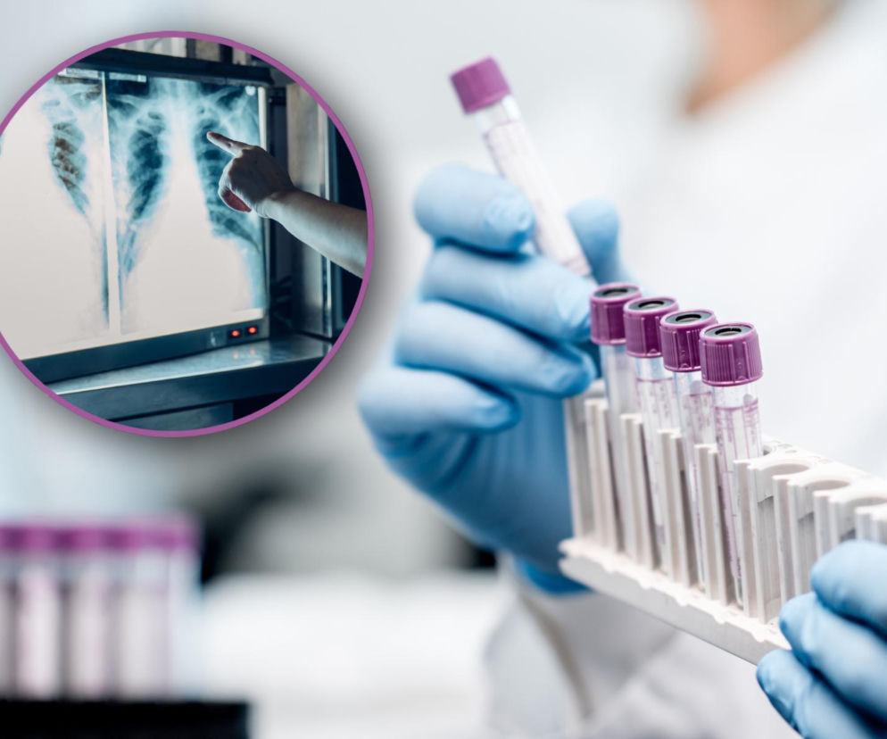 W szkole potwierdzono przypadek gruźlicy. Sanepid wydał pilny komunikat