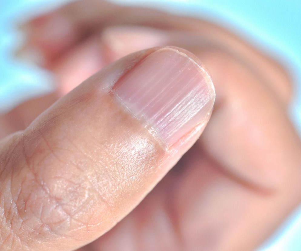 Pionowe bruzdy na paznokciu kciuka, symbolizujące ważny sygnał od organizmu o potencjalnych niedoborach witamin i minerałów. Na Poradnik Zdrowie znajdziesz więcej informacji o tym, co oznaczają takie zmiany.