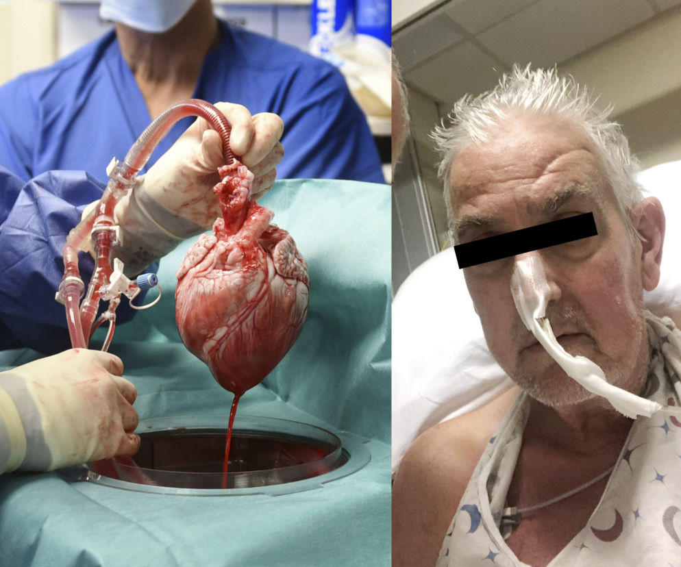 Przeszczepili mu serce świni, teraz wyszła na jaw jego brutalna przeszłość. To on!