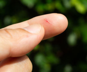 Woda utleniona na skaleczenie? To błąd, który niszczy tkanki. Sprawdź, co radzą lekarze