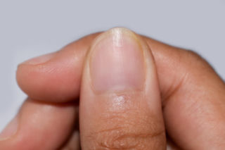 Masz takie zmiany w półksiężycu na paznokciu? Mogą zdradzać ukryte problemy z sercem i tarczycą