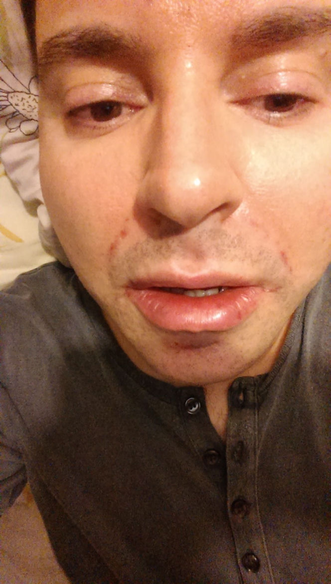 Michał Witkowski wstrzykuje sobie botoks i powiększa usta!