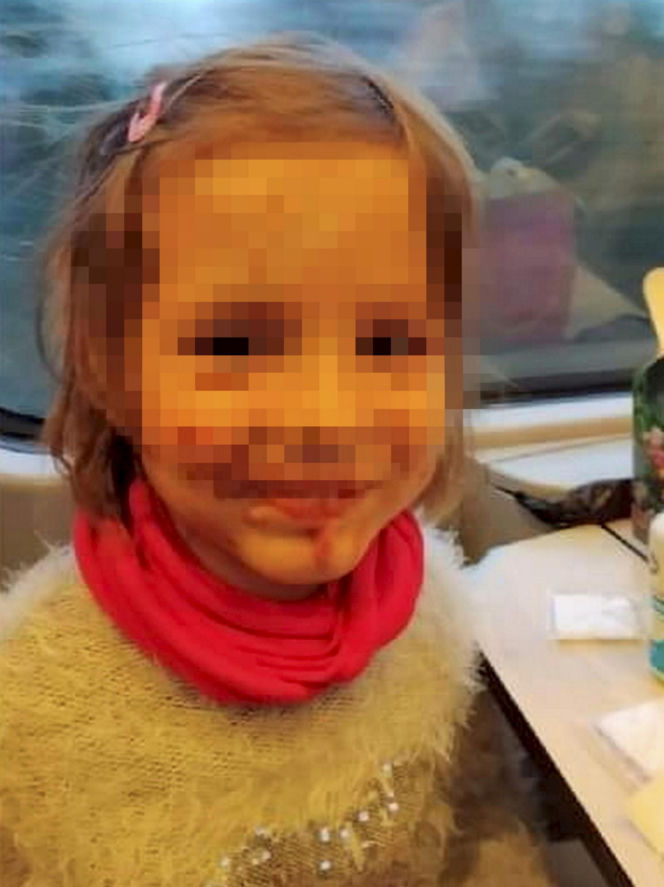 Wyrodna matka zgotowała Julce piekło. Latami wypalała jej kwasem rany na skórze!