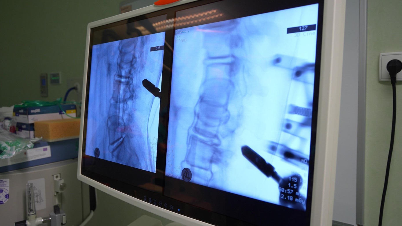Ponad sto operacji kręgosłupów z udziałem robota w szpitalu wojewódzkim w Szczecinie