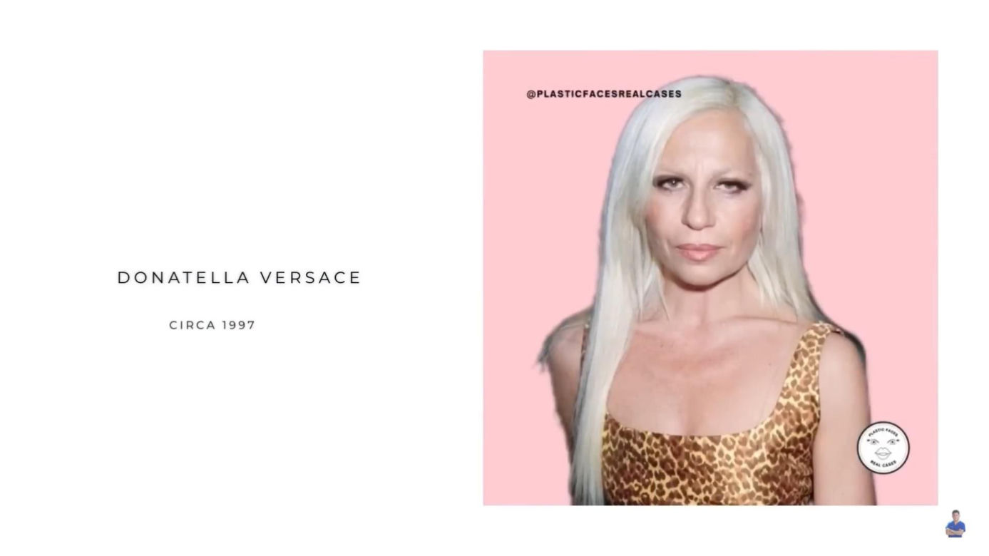 Donatella Versace  przed operacjami 