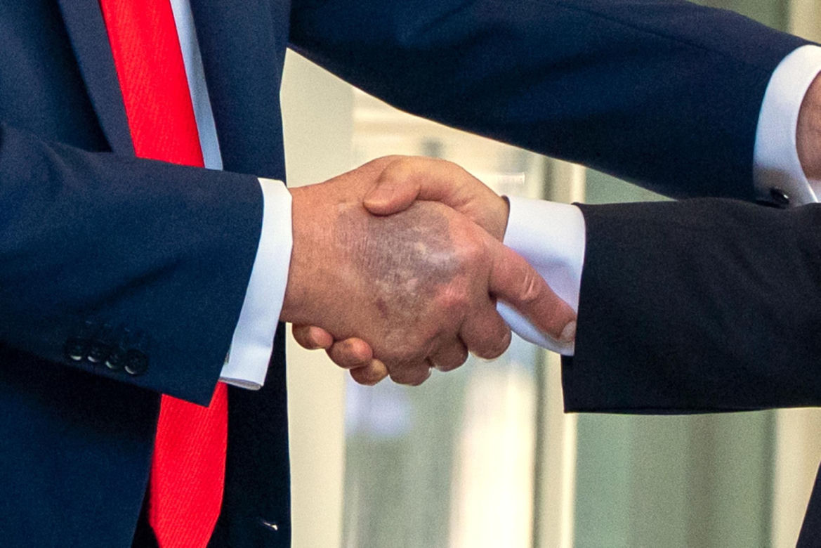 Donald Trump ma kłopoty ze zdrowiem. Nowe zdjęcia wywołały niepokój