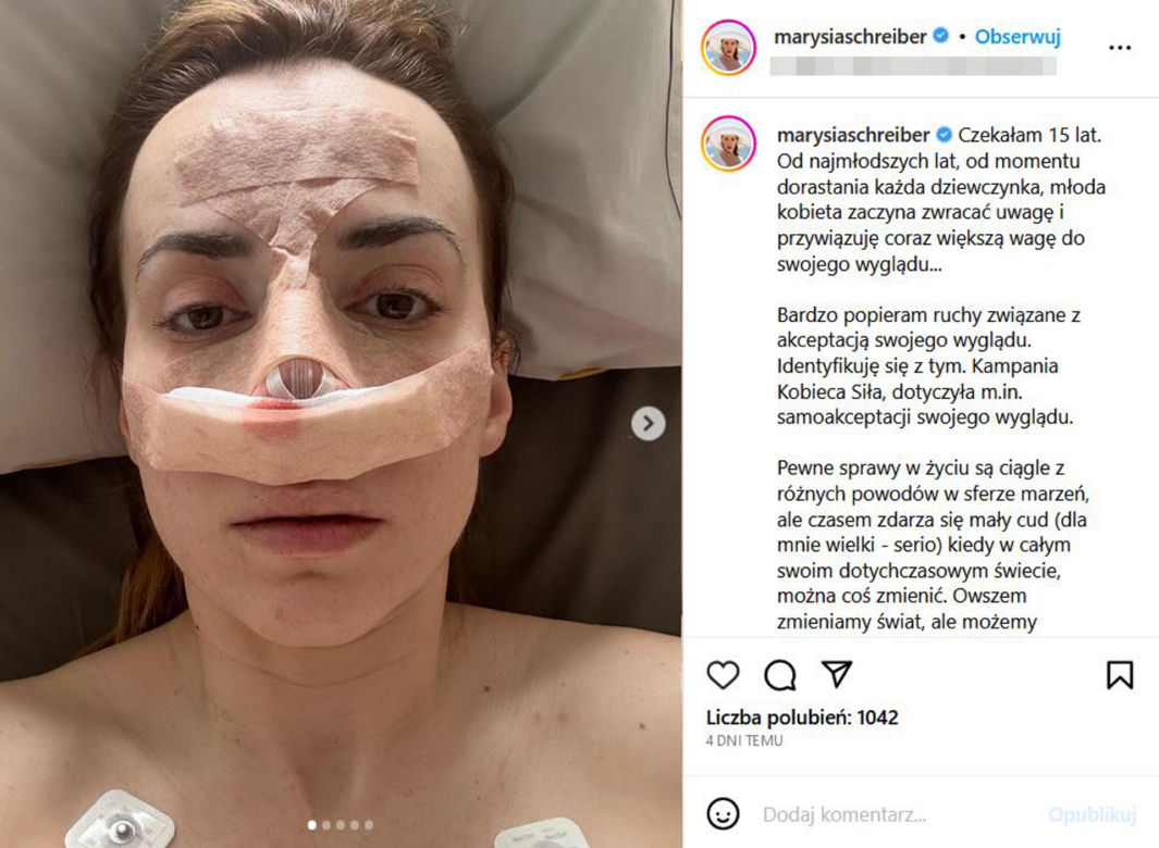 Tak wygląda Marianna Schreiber po operacji nosa