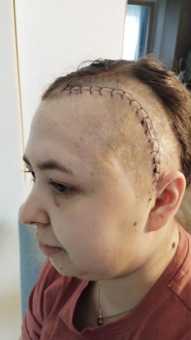 Życie Moniki wywróciło się do góry nogami. Torunianka walczy z glejakiem