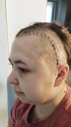 Życie Moniki wywróciło się do góry nogami. Torunianka walczy z glejakiem