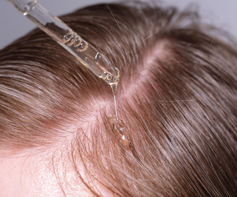 Hair slugging bije rekordy popularności. Ale przez jeden błąd cierpi skóra głowy
