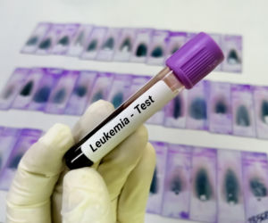 Mylimy ją ze zwykłym zmęczeniem. Hematolog ostrzega: ta białaczka zabija w kilka miesięcy