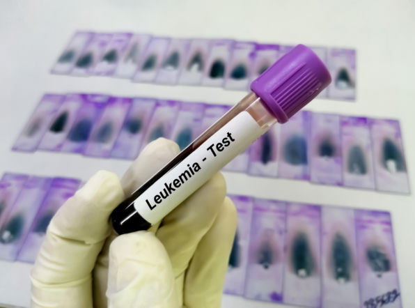 Mylimy ją ze zwykłym zmęczeniem. Hematolog ostrzega: ta białaczka zabija w kilka miesięcy