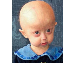 Progeria