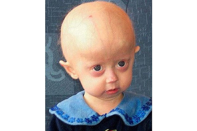 Progeria