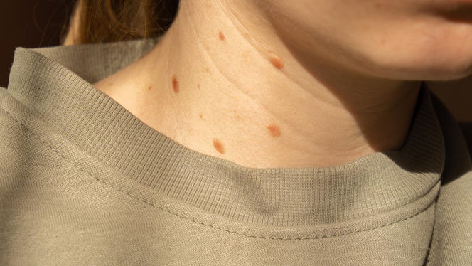 Wyglądają jak drobny defekt, a mogą zdradzać problemy z insuliną. Wysyp włókniaków to ważny sygnał od organizmu
