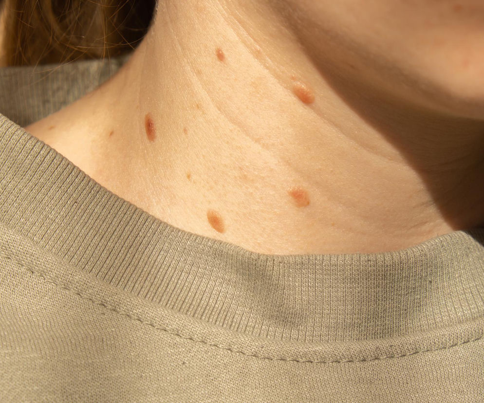 Skóra szyi i obojczyków osoby w beżowej bluzie, widoczne liczne, drobne włókniaki. Temat występowania włókniaków oraz ich związku z insulinoopornością i cukrzycą możesz zgłębić na portalu Poradnik Zdrowie.