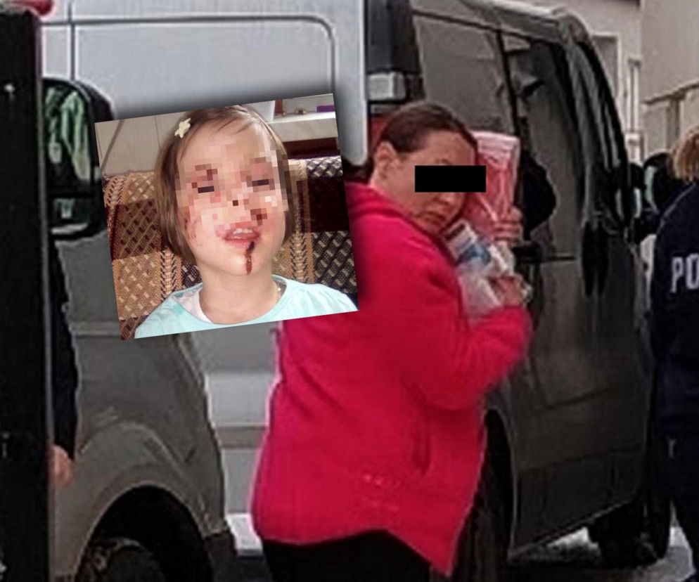 Wyrodna matka zgotowała Julce piekło. Latami wypalała jej kwasem rany na skórze!