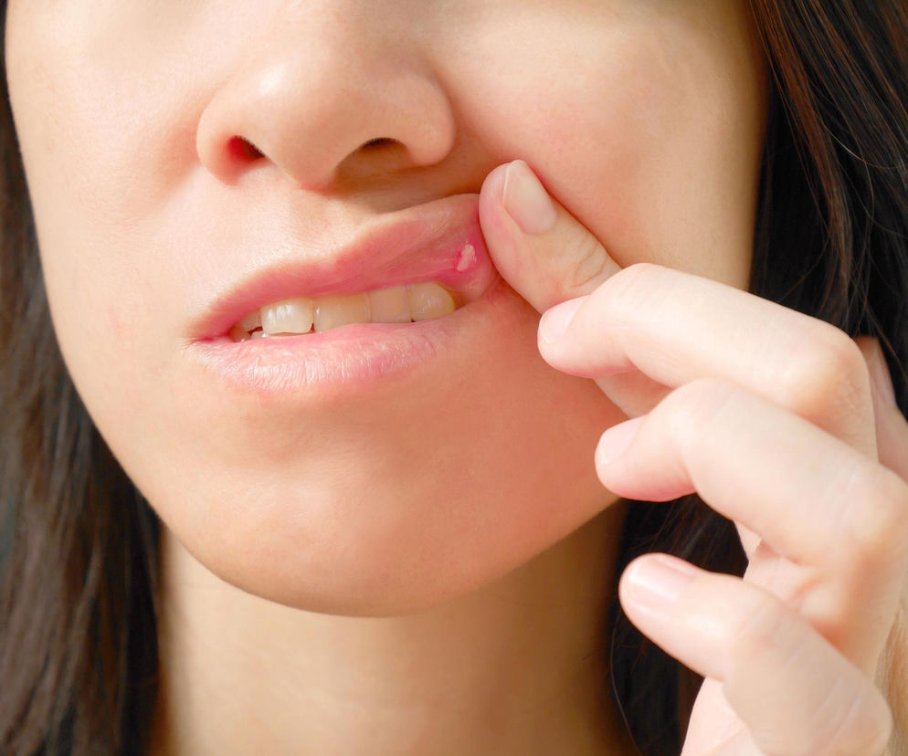 Kobieta pokazująca palcem bolesną aftę na wewnętrznej stronie dolnej wargi, z widoczną zaczerwienioną otoczką wokół jasnej zmiany, sygnalizującą problem, o którym przeczytasz na Poradnik Zdrowie.