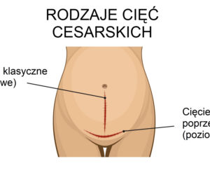 Rodzaje cięć cesarskich