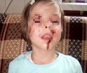 Wyrodna matka zgotowała Julce piekło. Latami wypalała jej kwasem rany na skórze!