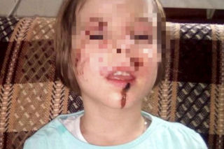 Wyrodna matka zgotowała Julce piekło. Latami wypalała jej kwasem rany na skórze!