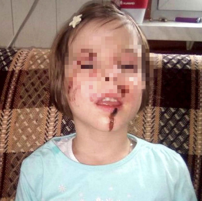 Wyrodna matka zgotowała Julce piekło. Latami wypalała jej kwasem rany na skórze!