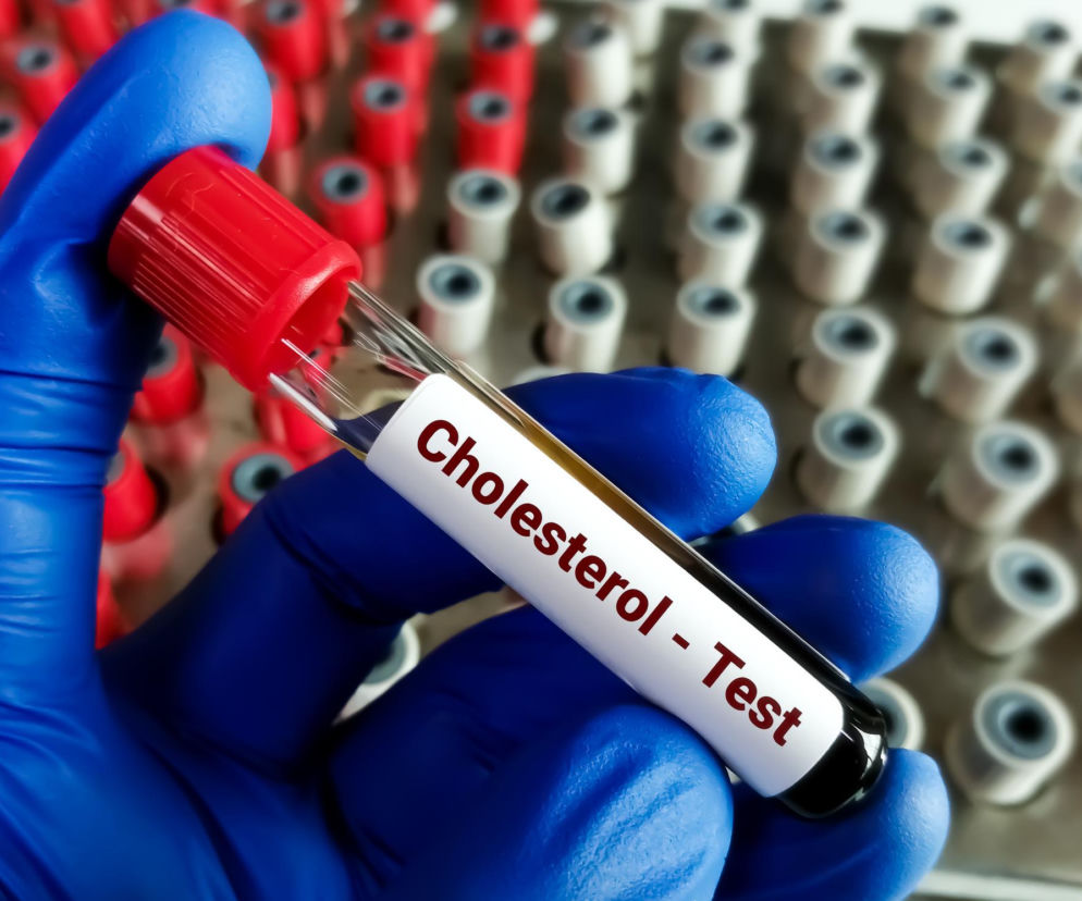 Dłoń w niebieskiej rękawiczce trzyma probówkę z krwią i etykietą Cholesterol - Test, symbolizującą diagnostykę zaburzeń lipidowych. W tle rozmazane inne probówki. To kluczowe badanie, o którym przeczytasz więcej na Poradnik Zdrowie.