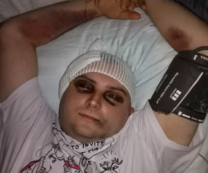 Wymienili mi pół głowy