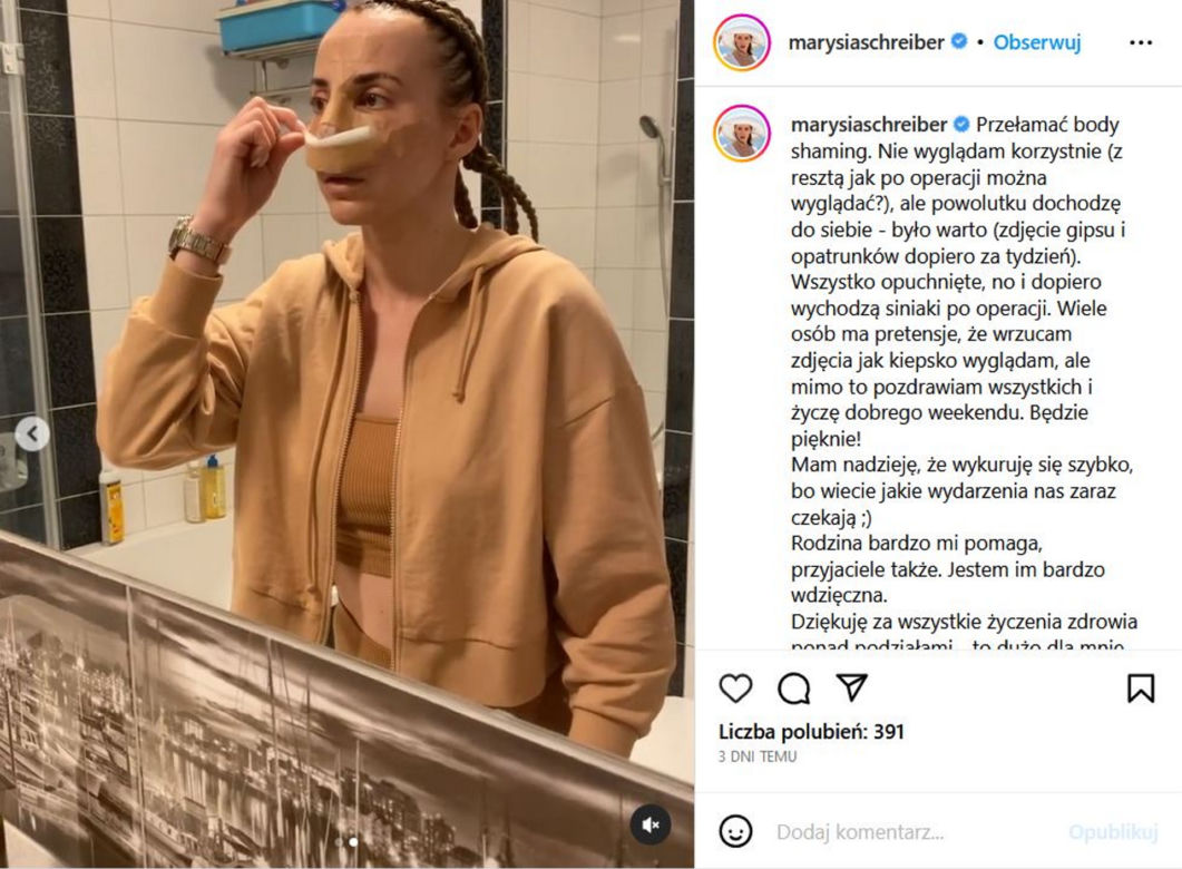 Tak wygląda Marianna Schreiber po operacji nosa