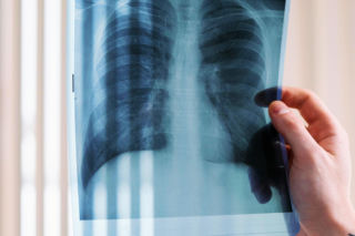 Nauczycielka z gruźlicą zakażała w szkole?! Uczniowie pilnie do przebadania!