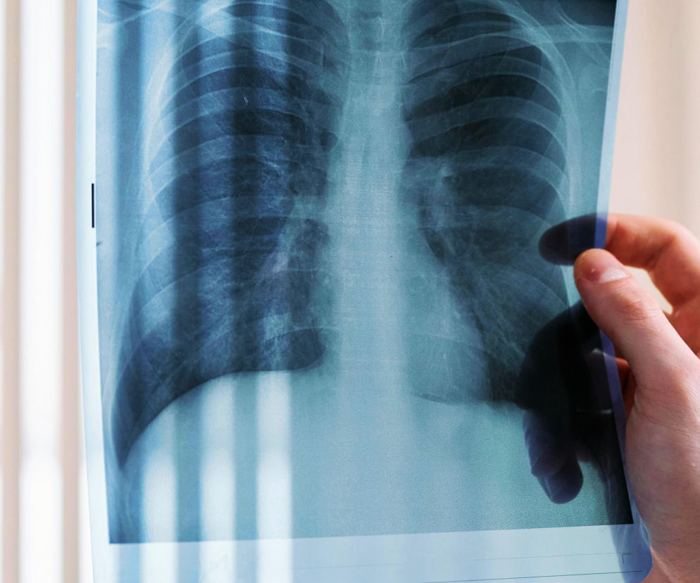 Nauczycielka z gruźlicą zakażała w szkole?! Uczniowie pilnie do przebadania!