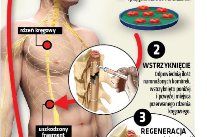 Sparaliżowany zaczął chodzić!