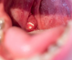 Białe grudki w gardle? Lekarze wyjaśniają, skąd się biorą. To częsta przyczyna nieświeżego oddechu