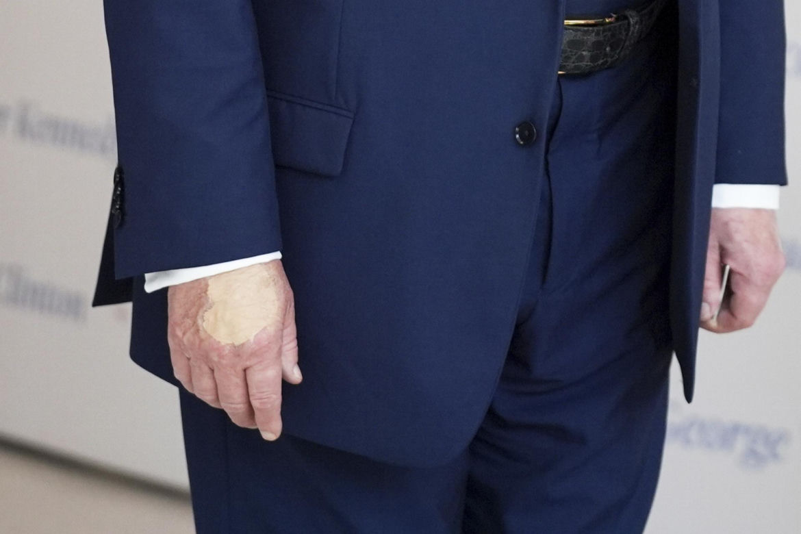 Donald Trump ma kłopoty ze zdrowiem. Nowe zdjęcia wywołały niepokój