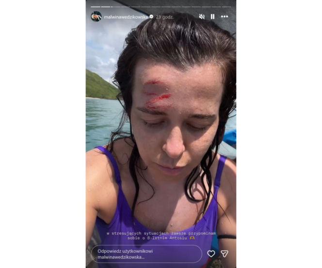 Gwiazda TVN poturbowana! Malwina Wędzikowska pokazała zakrwawioną twarz