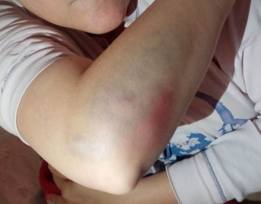 Potrącenie pieszej na pasach na rondzie santockim w Gorzowie. Poszkodowana pokazała poobijane ciało