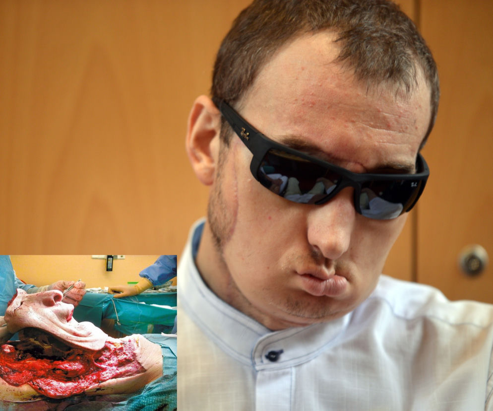 przeszczep twarzy pacjent wyszedl do domu (0)