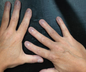 Złącz dwa palce i sprawdź, czy widzisz okienko. Ten banalny test może uratować ci życie