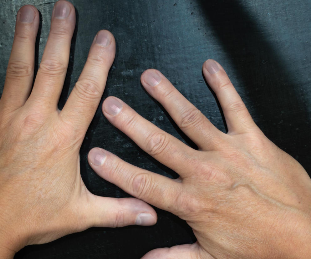 Dwie jasne dłonie osoby dorosłej ułożone dłońmi do góry na ciemnym tle, ukazujące palce rozłożone. Ilustracja do artykułu o teście okienka Schamrotha i palcach pałeczkowatych, więcej informacji na Poradnik Zdrowie.